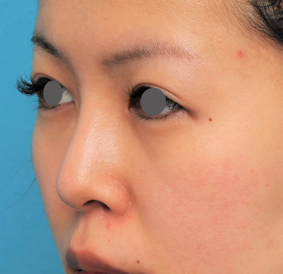 隆鼻術（シリコンプロテーゼ）,鼻にシリコンプロテーゼを入れ、自然な範囲内で鼻筋を通した症例写真,After（6ヶ月後）,ba_ryubi1057_b04.jpg