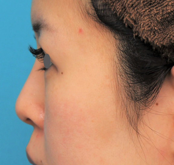 隆鼻術（シリコンプロテーゼ）,鼻にシリコンプロテーゼを入れ、自然な範囲内で鼻筋を通した症例写真,After（6ヶ月後）,ba_ryubi1057_b05.jpg