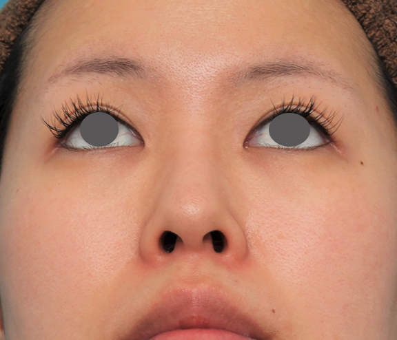 隆鼻術（シリコンプロテーゼ）,鼻にシリコンプロテーゼを入れ、自然な範囲内で鼻筋を通した症例写真,After（6ヶ月後）,ba_ryubi1057_b06.jpg