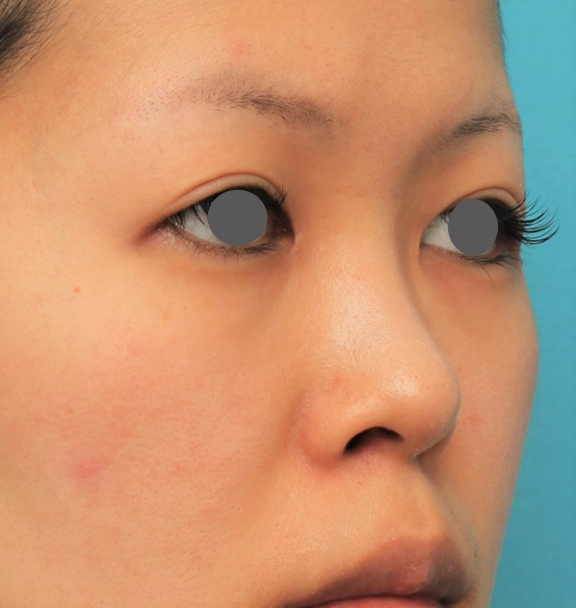 隆鼻術（シリコンプロテーゼ）,鼻にシリコンプロテーゼを入れ、自然な範囲内で鼻筋を通した症例写真,Before,ba_ryubi1057_b02.jpg