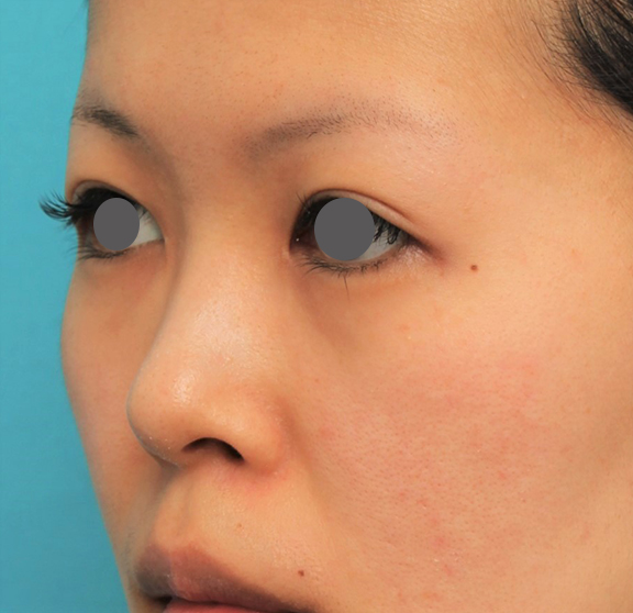 症例写真,鼻にシリコンプロテーゼを入れ、自然な範囲内で鼻筋を通した症例写真,Before,ba_ryubi1057_b04.jpg