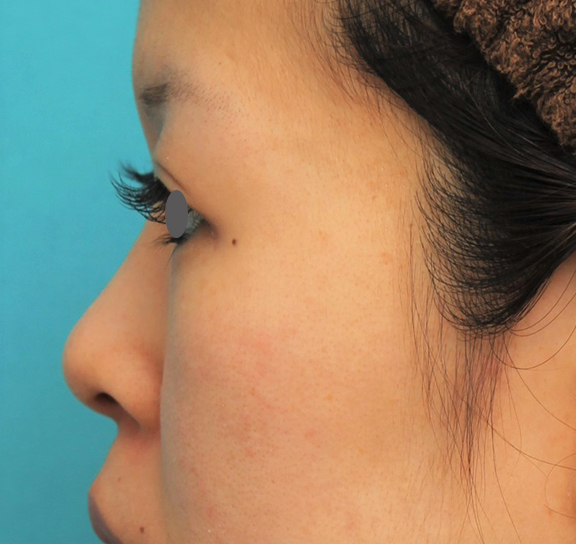 隆鼻術（シリコンプロテーゼ）,鼻にシリコンプロテーゼを入れ、自然な範囲内で鼻筋を通した症例写真,Before,ba_ryubi1057_b05.jpg