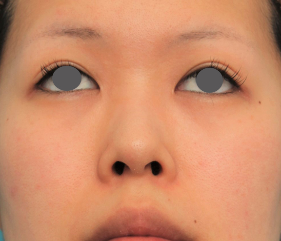 隆鼻術（シリコンプロテーゼ）,鼻にシリコンプロテーゼを入れ、自然な範囲内で鼻筋を通した症例写真,Before,ba_ryubi1057_b06.jpg