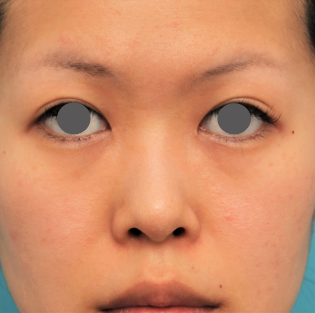 隆鼻術（シリコンプロテーゼ）,鼻にシリコンプロテーゼを入れ、自然な範囲内で鼻筋を通した症例写真,手術前,mainpic_ryubi1057a.jpg