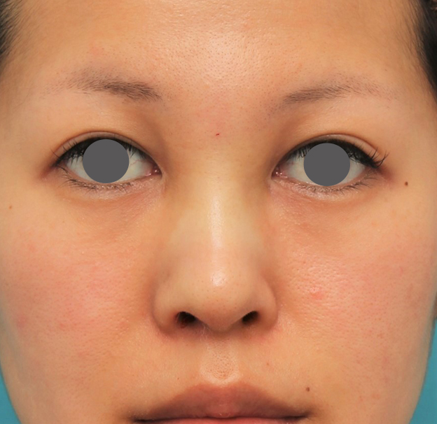 隆鼻術（シリコンプロテーゼ）,鼻にシリコンプロテーゼを入れ、自然な範囲内で鼻筋を通した症例写真,手術直後,mainpic_ryubi1057b.jpg