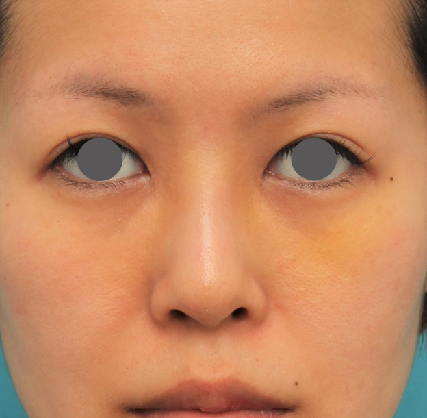隆鼻術（シリコンプロテーゼ）,鼻にシリコンプロテーゼを入れ、自然な範囲内で鼻筋を通した症例写真,1週間後,mainpic_ryubi1057c.jpg