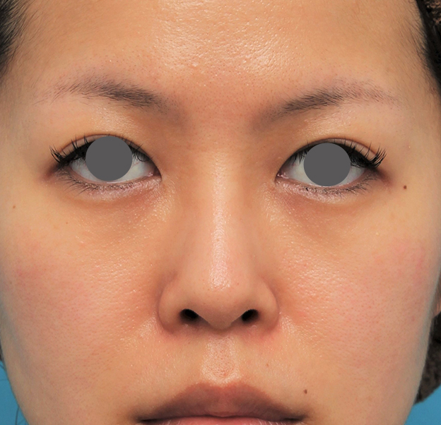 隆鼻術（シリコンプロテーゼ）,鼻にシリコンプロテーゼを入れ、自然な範囲内で鼻筋を通した症例写真,2ヶ月後,mainpic_ryubi1057e.jpg