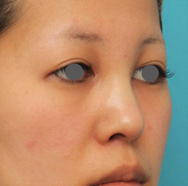 隆鼻術（シリコンプロテーゼ）,鼻にシリコンプロテーゼを入れ、自然な範囲内で鼻筋を通した症例写真,手術直後,mainpic_ryubi1057h.jpg