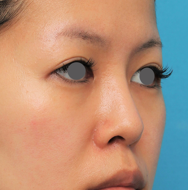 隆鼻術（シリコンプロテーゼ）,鼻にシリコンプロテーゼを入れ、自然な範囲内で鼻筋を通した症例写真,2ヶ月後,mainpic_ryubi1057k.jpg