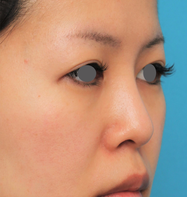 隆鼻術（シリコンプロテーゼ）,鼻にシリコンプロテーゼを入れ、自然な範囲内で鼻筋を通した症例写真,6ヶ月後,mainpic_ryubi1057l.jpg