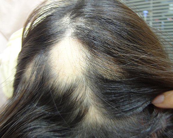 AGA治療（高須式メディカル育毛プログラム）,女性の薄毛治療,HARG治療（女性の円形脱毛）の症例写真,Before,ba_aga_josei001_b.jpg