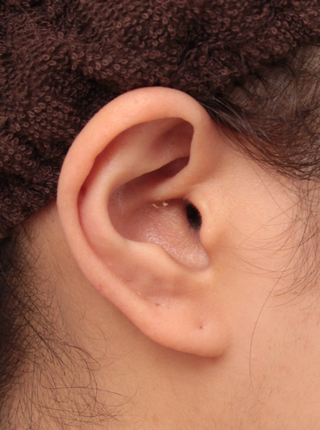ガミースマイル手術,耳介軟骨移植でガミースマイルを永久的に治した症例写真,手術前,mainpic_gammy_005h.jpg