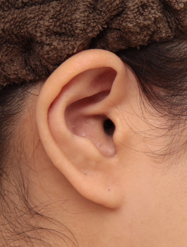 ガミースマイル手術,耳介軟骨移植でガミースマイルを永久的に治した症例写真,1年後,mainpic_gammy_005k.jpg