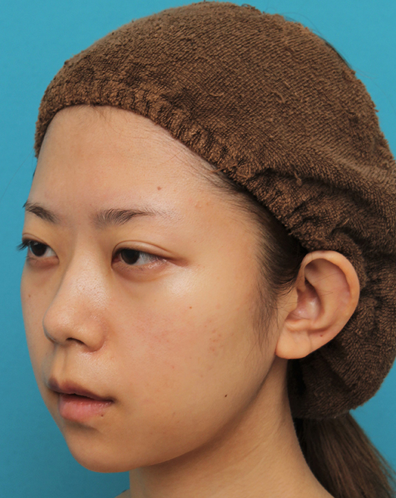 あご形成（シリコンプロテーゼ）,引っ込んでいる顎をシリコンプロテーゼで前方に出した20代女性の症例写真,After（6ヶ月後）,ba_ago020_b02.jpg