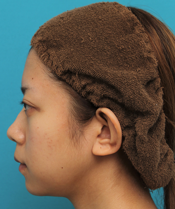 あご形成（シリコンプロテーゼ）,引っ込んでいる顎をシリコンプロテーゼで前方に出した20代女性の症例写真,After（6ヶ月後）,ba_ago020_b03.jpg