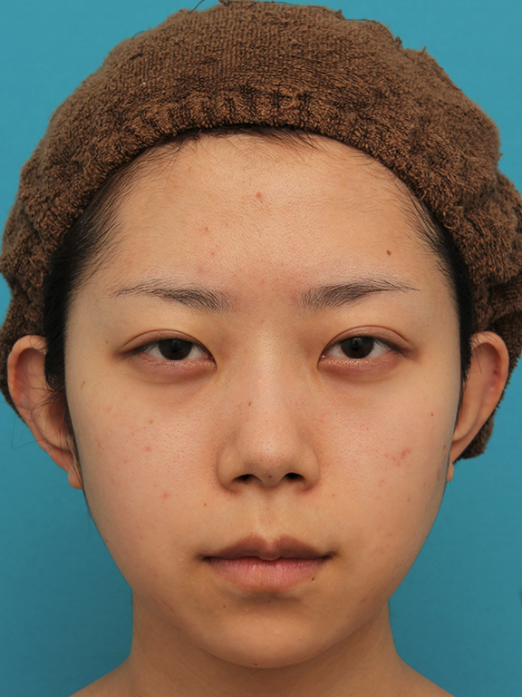 あご形成（シリコンプロテーゼ）,引っ込んでいる顎をシリコンプロテーゼで前方に出した20代女性の症例写真,Before,ba_ago020_b01.jpg