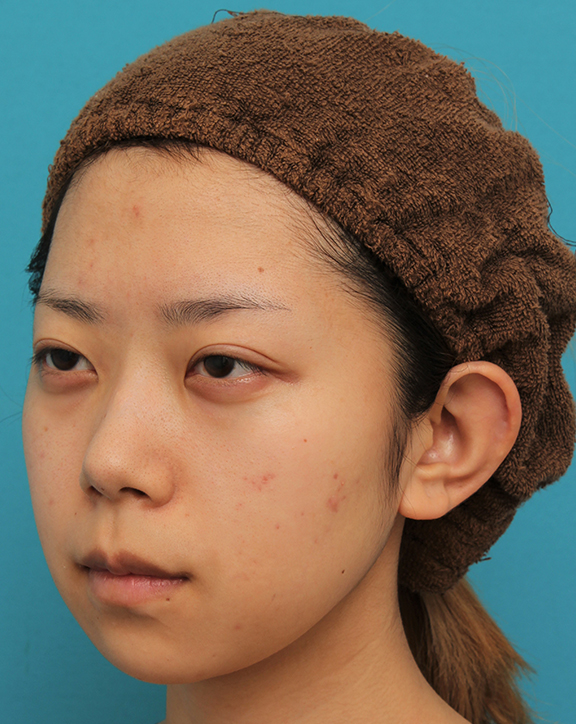 あご形成（シリコンプロテーゼ）,引っ込んでいる顎をシリコンプロテーゼで前方に出した20代女性の症例写真,Before,ba_ago020_b02.jpg