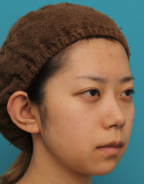 症例写真,引っ込んでいる顎をシリコンプロテーゼで前方に出した20代女性の症例写真,Before,ba_ago020_b04.jpg
