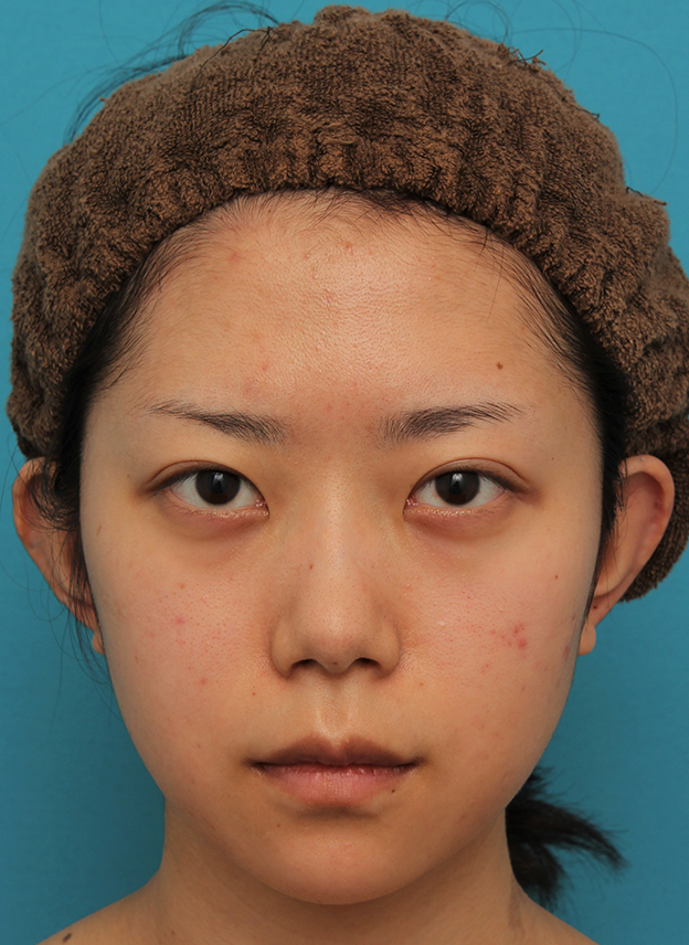 あご形成（シリコンプロテーゼ）,引っ込んでいる顎をシリコンプロテーゼで前方に出した20代女性の症例写真,2週間後,mainpic_ago020d.jpg