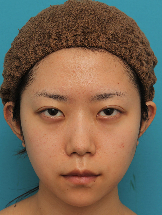 あご形成（シリコンプロテーゼ）,引っ込んでいる顎をシリコンプロテーゼで前方に出した20代女性の症例写真,1ヶ月後,mainpic_ago020e.jpg