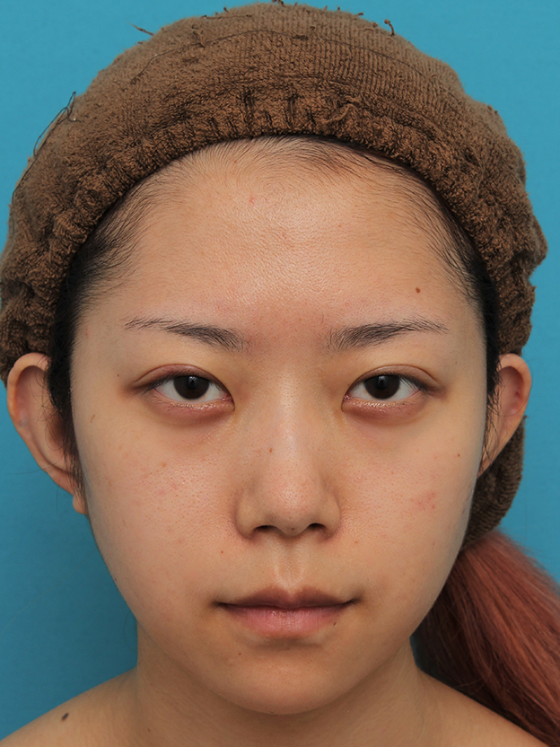 あご形成（シリコンプロテーゼ）,引っ込んでいる顎をシリコンプロテーゼで前方に出した20代女性の症例写真,2ヶ月後,mainpic_ago020f.jpg