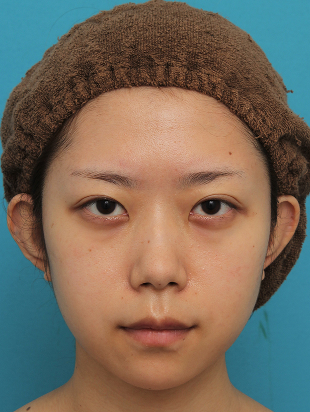 あご形成（シリコンプロテーゼ）,引っ込んでいる顎をシリコンプロテーゼで前方に出した20代女性の症例写真,6ヶ月後,mainpic_ago020g.jpg
