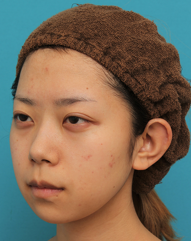 あご形成（シリコンプロテーゼ）,引っ込んでいる顎をシリコンプロテーゼで前方に出した20代女性の症例写真,手術前,mainpic_ago020h.jpg