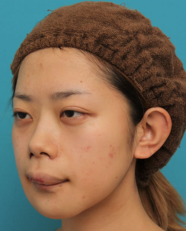 あご形成（シリコンプロテーゼ）,引っ込んでいる顎をシリコンプロテーゼで前方に出した20代女性の症例写真,手術直後,mainpic_ago020i.jpg