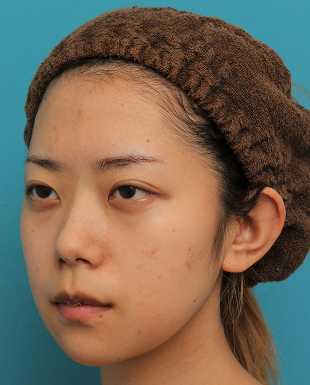 あご形成（シリコンプロテーゼ）,引っ込んでいる顎をシリコンプロテーゼで前方に出した20代女性の症例写真,1週間後,mainpic_ago020j.jpg