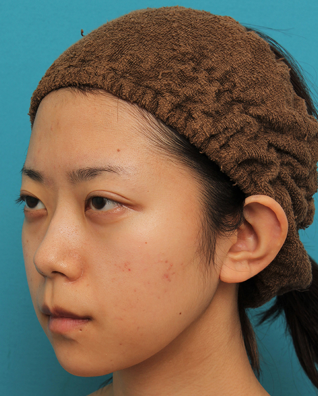 あご形成（シリコンプロテーゼ）,引っ込んでいる顎をシリコンプロテーゼで前方に出した20代女性の症例写真,1ヶ月後,mainpic_ago020l.jpg