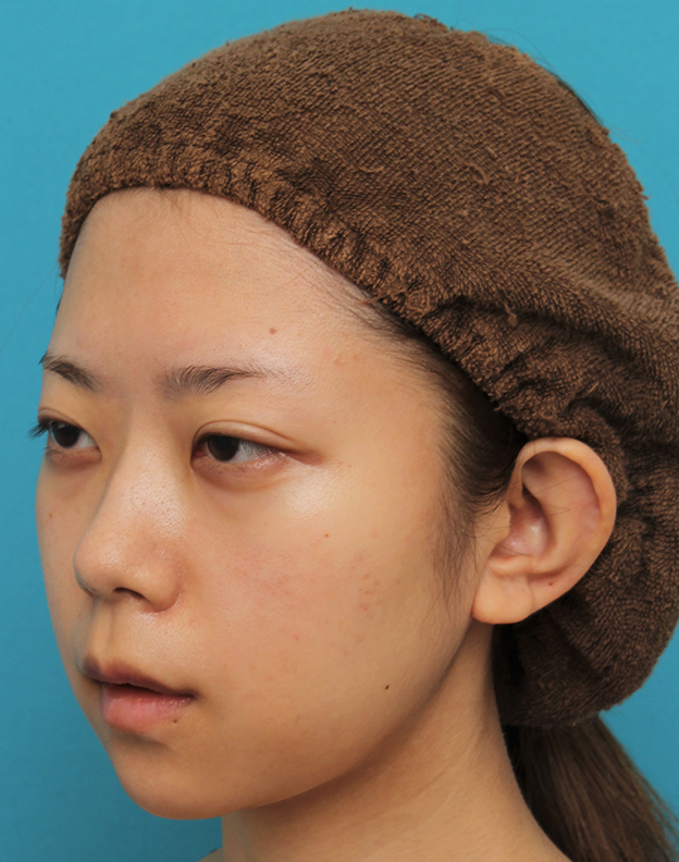 あご形成（シリコンプロテーゼ）,引っ込んでいる顎をシリコンプロテーゼで前方に出した20代女性の症例写真,6ヶ月後,mainpic_ago020n.jpg