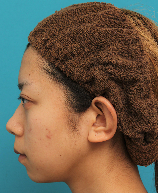 あご形成（シリコンプロテーゼ）,引っ込んでいる顎をシリコンプロテーゼで前方に出した20代女性の症例写真,手術前,mainpic_ago020o.jpg