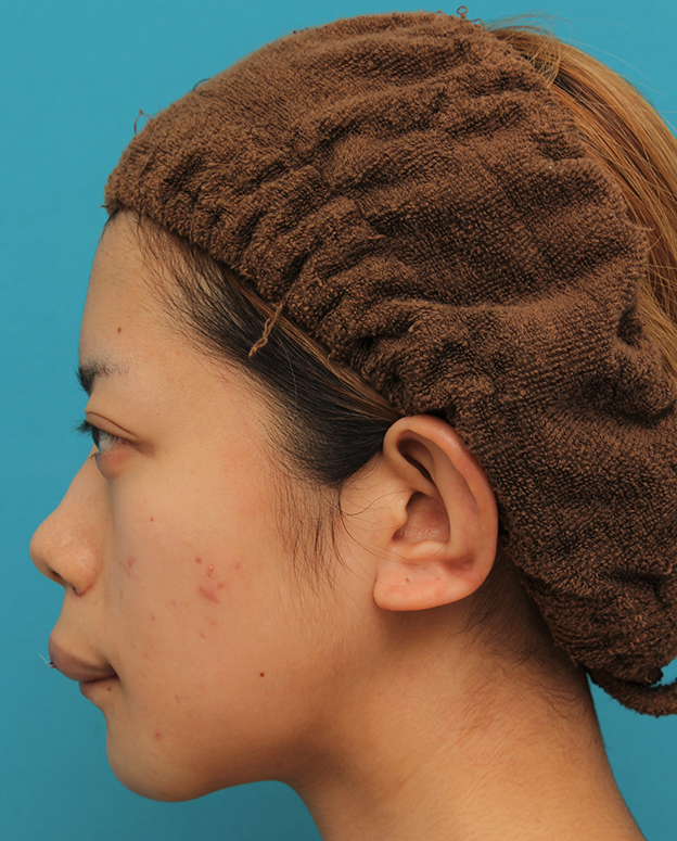 あご形成（シリコンプロテーゼ）,引っ込んでいる顎をシリコンプロテーゼで前方に出した20代女性の症例写真,手術直後,mainpic_ago020p.jpg