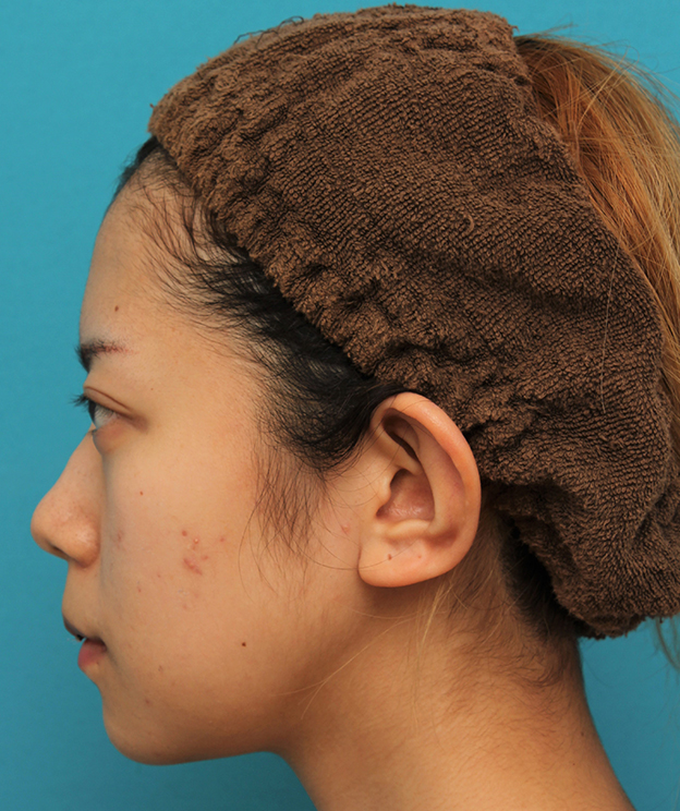 あご形成（シリコンプロテーゼ）,引っ込んでいる顎をシリコンプロテーゼで前方に出した20代女性の症例写真,1週間後,mainpic_ago020q.jpg