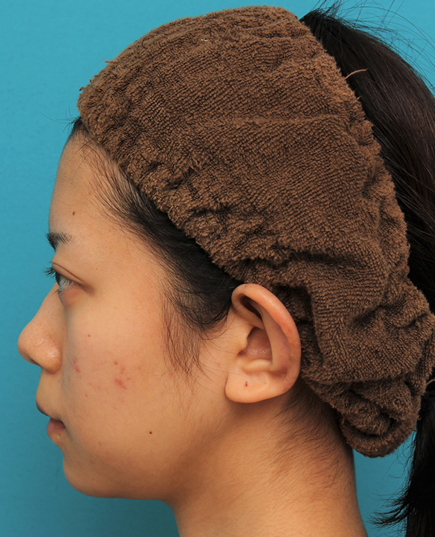 あご形成（シリコンプロテーゼ）,引っ込んでいる顎をシリコンプロテーゼで前方に出した20代女性の症例写真,2週間後,mainpic_ago020r.jpg
