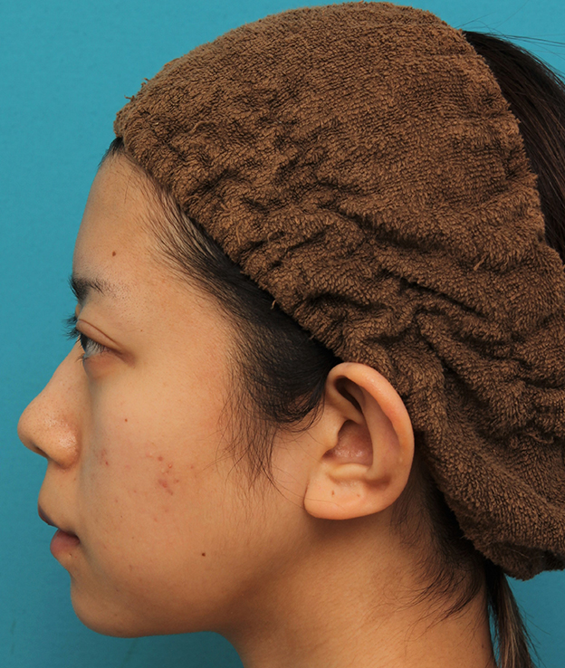 あご形成（シリコンプロテーゼ）,引っ込んでいる顎をシリコンプロテーゼで前方に出した20代女性の症例写真,1ヶ月後,mainpic_ago020s.jpg