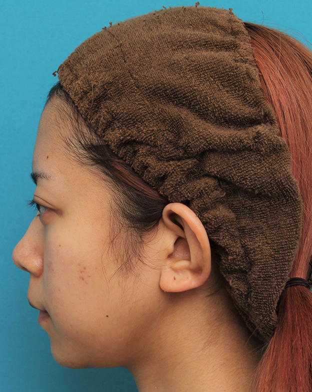 あご形成（シリコンプロテーゼ）,引っ込んでいる顎をシリコンプロテーゼで前方に出した20代女性の症例写真,2ヶ月後,mainpic_ago020t.jpg