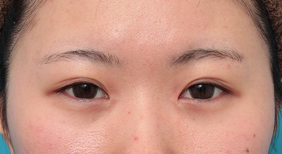他院で受けた手術の修正（二重まぶた・目もと）,他院で切りすぎてしまった目頭切開を蒙古襞形成で修正手術した症例写真,After（6ヶ月後）,ba_hida010_b01.jpg