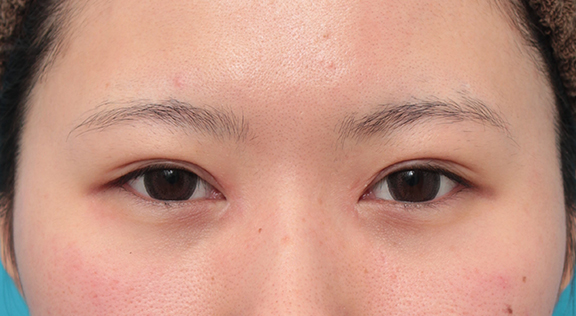他院で受けた手術の修正（二重まぶた・目もと）,他院で切りすぎてしまった目頭切開を蒙古襞形成で修正手術した症例写真,Before,ba_hida010_b01.jpg