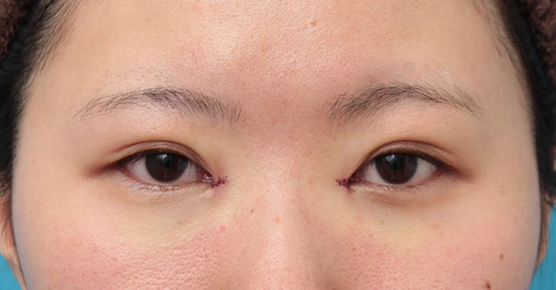 他院で受けた手術の修正（二重まぶた・目もと）,他院で切りすぎてしまった目頭切開を蒙古襞形成で修正手術した症例写真,手術直後,mainpic_hida010b.jpg