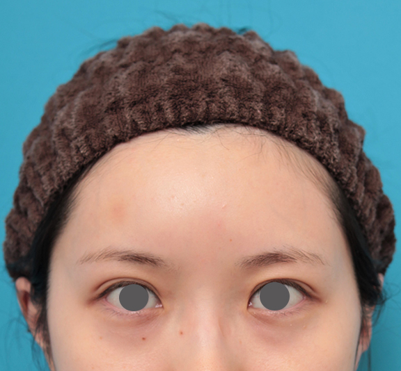 額のヒアルロン酸注射（おでこをぽっこり丸く出すor堀を深くする）,ヒアルロン酸注射で額を丸く出した20代女性の症例写真,After（翌日）,ba_hitai_hyaluron007_b03.jpg