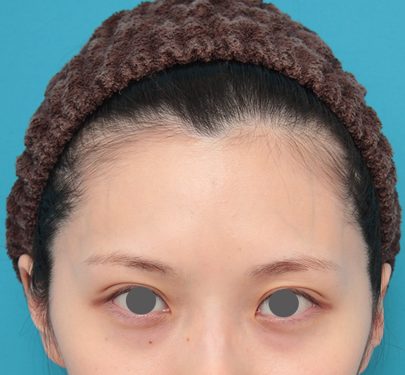 額のヒアルロン酸注射（おでこをぽっこり丸く出すor堀を深くする）,ヒアルロン酸注射で額を丸く出した20代女性の症例写真,Before,ba_hitai_hyaluron007_b03.jpg