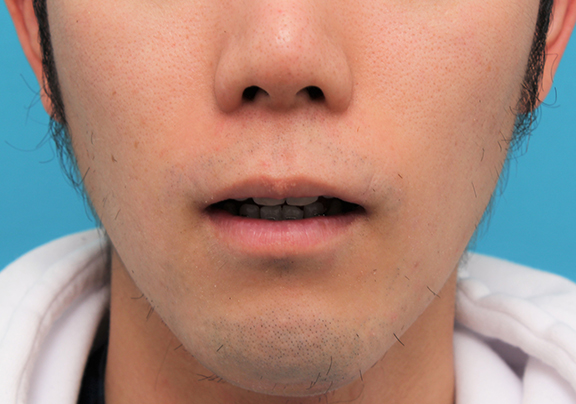 唇を薄く（口唇縮小術）,手術で薄めの唇にした症例写真,After（6ヶ月後）,ba_usuku015_b02.jpg