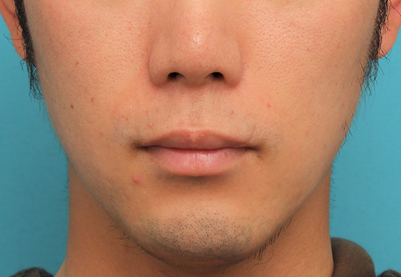 唇を薄く（口唇縮小術）,手術で薄めの唇にした症例写真,Before,ba_usuku015_b01.jpg