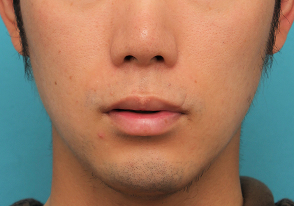 唇を薄く（口唇縮小術）,手術で薄めの唇にした症例写真,Before,ba_usuku015_b02.jpg