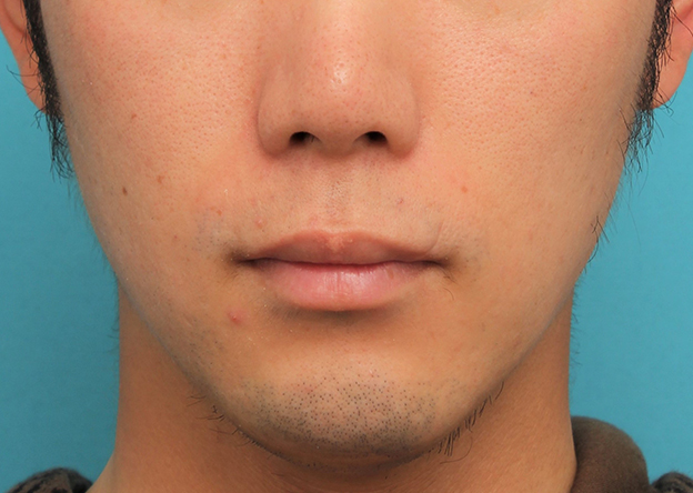 唇を薄く（口唇縮小術）,手術で薄めの唇にした症例写真,手術前,口を閉じた状態,mainpic_usuku015a.jpg