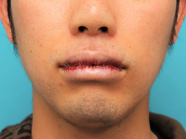 唇を薄く（口唇縮小術）,手術で薄めの唇にした症例写真,手術直後,mainpic_usuku015c.jpg