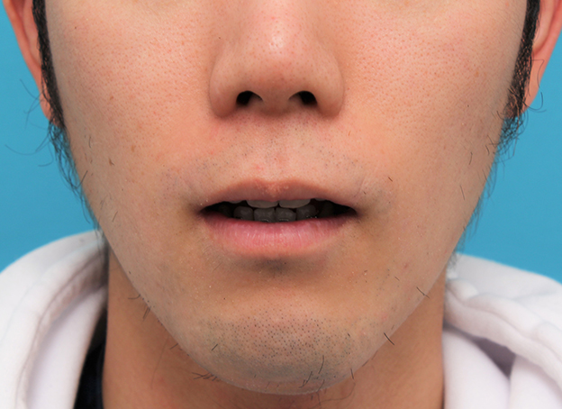 唇を薄く（口唇縮小術）,手術で薄めの唇にした症例写真,6ヶ月後,口を開けた状態,mainpic_usuku015i.jpg