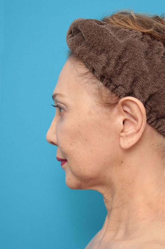 ネックリフト（首のたるみ取り手術）,ネックリフト（首のたるみ取り手術）の症例写真,Before,ba_necklift001_b02.jpg