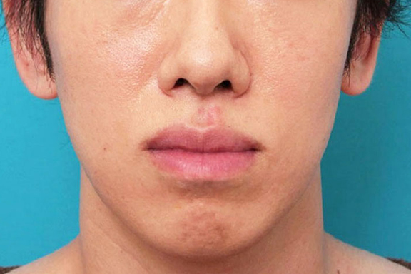 唇を薄く（口唇縮小術）,下唇を薄くした症例写真,After（6ヶ月後）,ba_usuku016_a01.jpg
